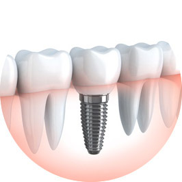 A graphic which describes how a tooth implant looks like from the medical viewpoint.